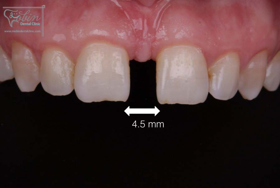 فاصله بین دندان ها در بسیاری موارد ژنتیکی است
